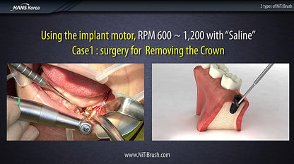 000_NiTi Brush for periimplantitis - 4 pieces mix for starter